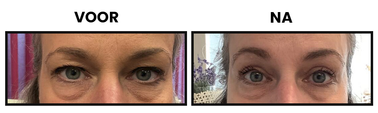 bovenooglidcorrectie bovenooglidcorrectie